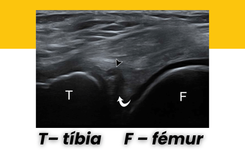 9. Evaluacion rodilla ecografia.png